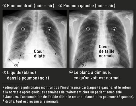 Insuffisance Cardiaque Bien Soigner Le C Ur Lactualit