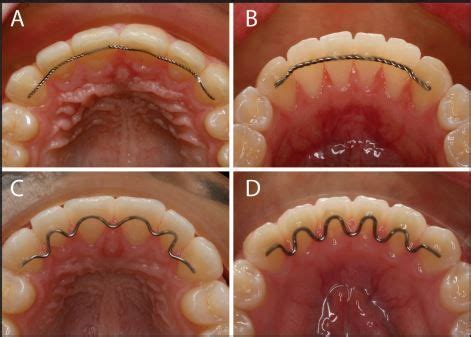 Orthodontic Bonded Retainers Orthodontics Permanent Retainer Dental