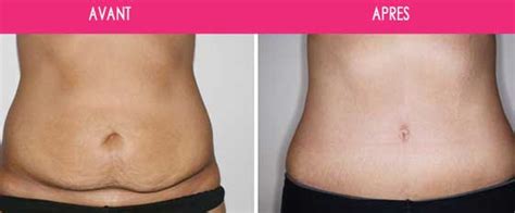 Abdominoplastie Tunisie Prix Chirurgie Du Ventre Tout Compris