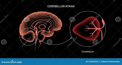 Ataxia Cerebellar Disorder Stock Vector Illustration Of Medical