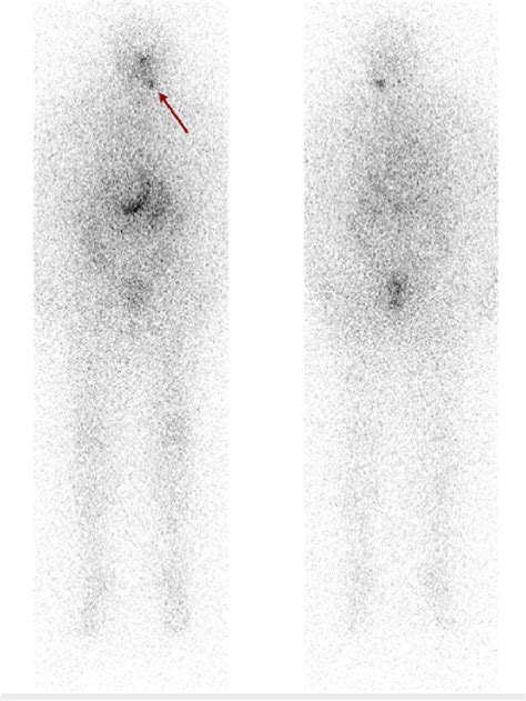 Anterior Left And Posterior Right Pre Therapy Thyrogenstimulated