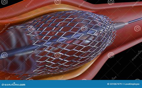 A 3D Rendering Of A Stent Inside A Blood Capillary Royalty Free Stock