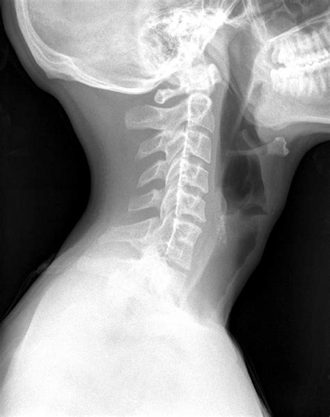 X-ray of the patient showing C6 and C7 vertebrae fusion. | Download ...