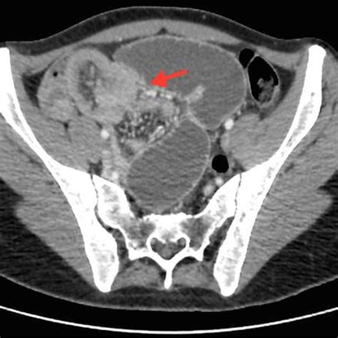 Pi Ce Op Ratoire De R Section Segmentaire Montrant Le Diverticule De