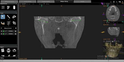 Temporomandibular Joint And Skeletal Changes In Response To Twin Block