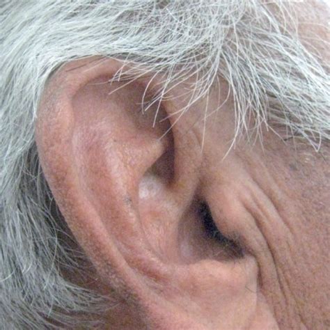 The same patient with a somewhat less distinct diagonal ear lobe crease... | Download Scientific ...