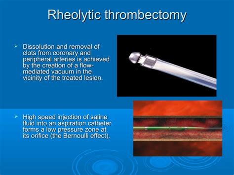 Saphenous Venous Graft Interventions Ppt