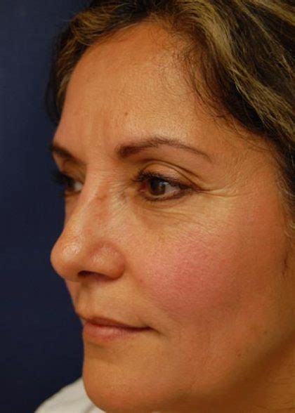 Patient Rhinoplasty Before And After Photos La Jolla Plastic