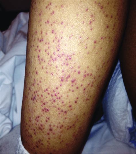 Painful Rash On Lower Leg