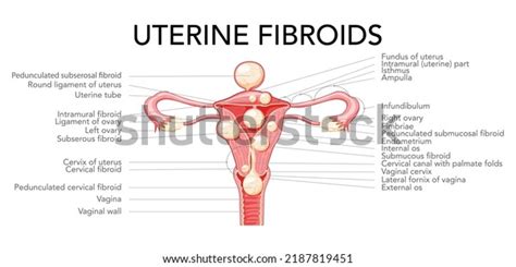 Uterine Fibroids Female Leiomyomas Reproductive System Stock Vector