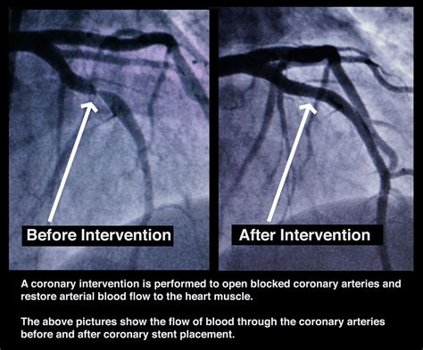 Coronary Angiogram & Stent Placement - New York Comprehensive Cardiology