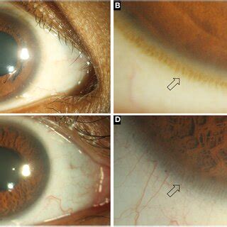 A Representative Collage Of Various Diagnostic Modalities In Limbal