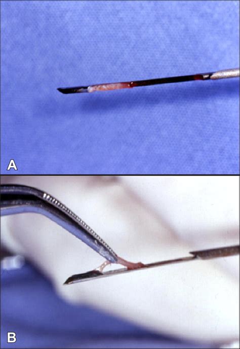 Photograph Showing The Tissue Specimen A In The Cutting Needle B Download Scientific