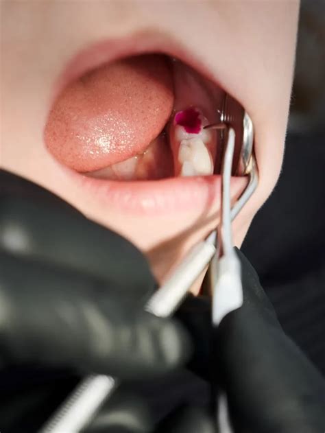 Removing Food Stuck In Wisdom Tooth Hole Effective Ways World Of