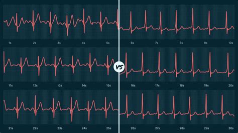 Sinus Rhythm Vs Wolff Parkinson White Syndrome On Your Watch Ecg Qaly