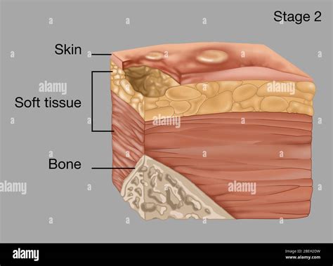 Stage 2 Of A Bedsore Illustration Stock Photo Alamy