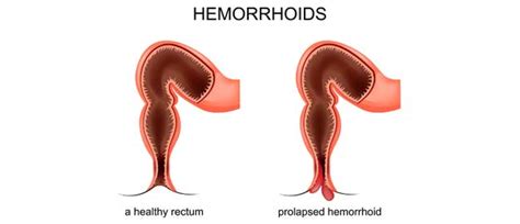 Hemorrhoid Doctor In Orange County Orange County Hemorrhoid Clinic