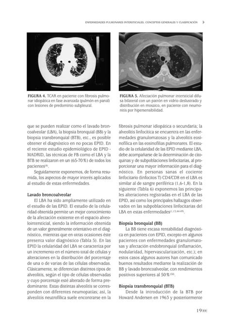 Enfermedades Pulmonares Intersticiales Difusas Pdf