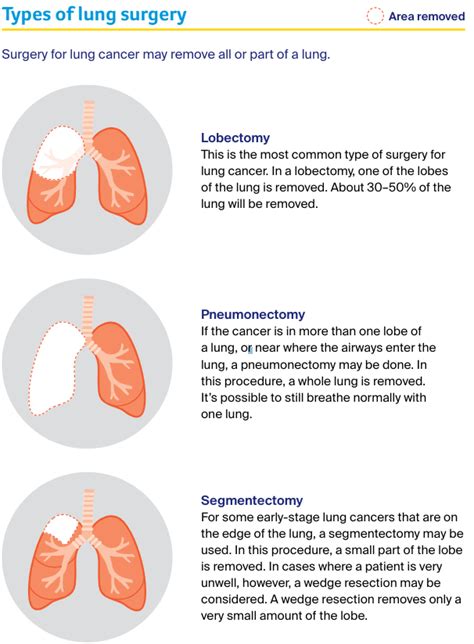 Lung Cancer Treatment Expert Guidance From Cancer Council Victoria