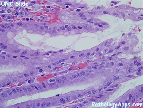 h pylori pathology