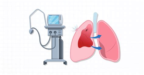 Ventilator Induced Lung Injury VILI An Overview 2025