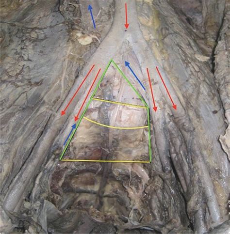 Figure 1 From Feasibility Of Anterior Pedicle Screw Fixation In