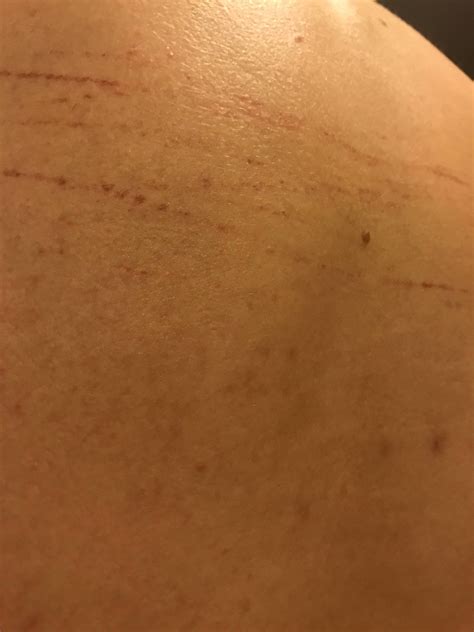 Unexplained Scratches On Back