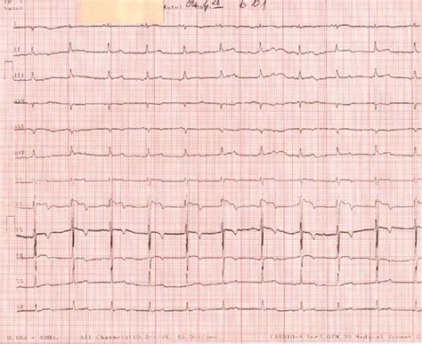 Resting Electrocardiogram On Admission In Medical Clinic Sinus Rhythm