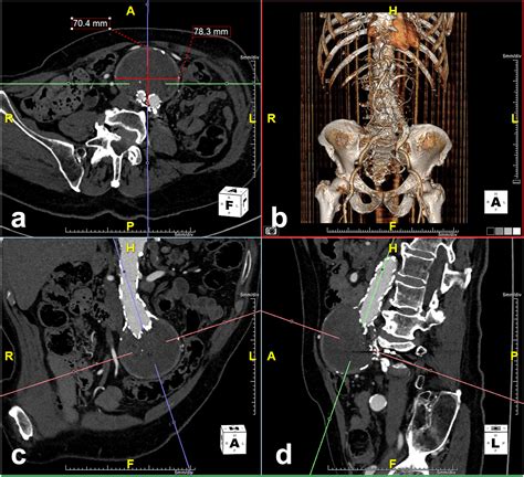 Direct Sac Puncture Versus Transarterial Embolization Of Type II