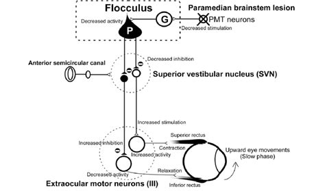 Schematic Of The Pathogenesis Of Downbeat Nystagmus Showing How