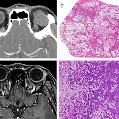 Pleomorphic Adenoma A B And Adenoid Cystic Carcinoma C D A Ct