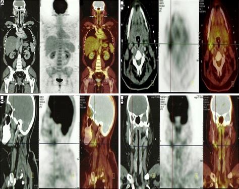 A female patient aged 27years with stage II-DLBCL, 1year after ...