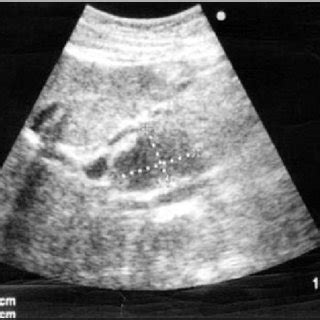 US abdomen showing a hypoechoic irregular mass 40 x 33 mm in the head... | Download Scientific ...