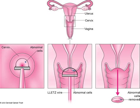 Cervical Screening Loop Diathermy Lletz