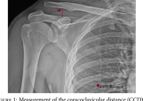 Figure 1 From Comparison Of The Hook Plate Versus Tightrope System In The Treatment Of Acute