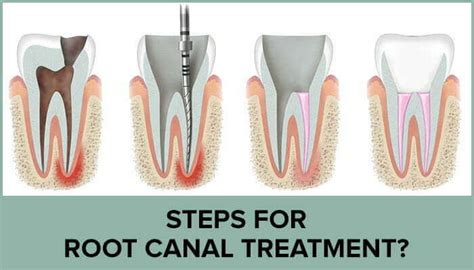 Dental Root Canal Treatment Endodontic In Malaysia Dental Home