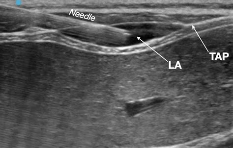 Transversus Abdominis Plane Block Uses Considerations Clinician S Brief