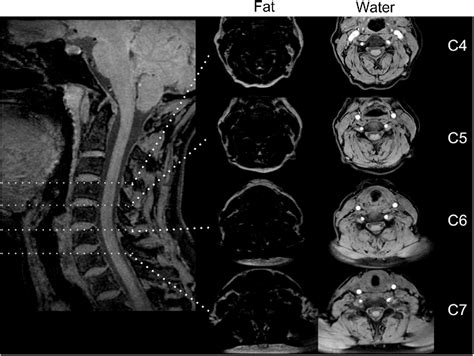 Figure 1 From The Qualitative Grading Of Muscle Fat Infiltration In