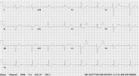 The Patients 12 Lead Electrocardiogram Download Scientific Diagram