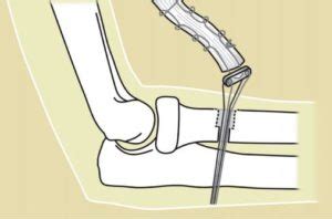 Distal Biceps Tear - Jackson Orthopaedics Jackson Orthopaedics