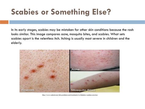 Ppt What Is Scabies Powerpoint Presentation Id2457230