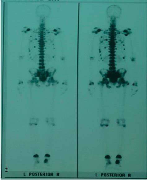 Technetium M Methyl Diphosphonate Whole Body Bone Scan Of A