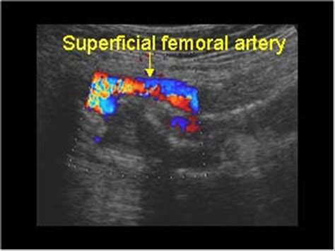 Peripheral vessels | 10.1 Peripheral arteries : Case 10.1.6 True ...