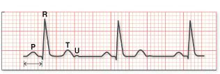 hyperkalemia vs hypokalemia ECG Flashcards | Quizlet