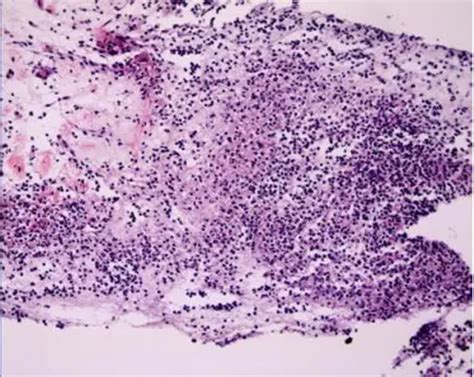 What is Nocardia Bacterial Infection? – Pathosomes