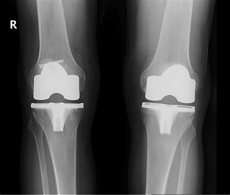 Total Knee Replacement Dr Mohamed Attia M D PhD