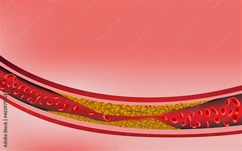 Stockvector Clogged Arteries Illustration Of An Artery Blocked With