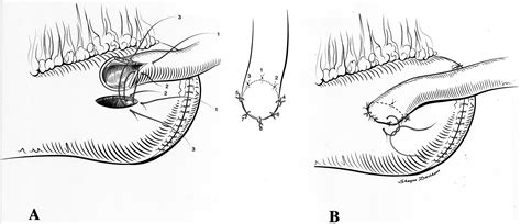 Comparison Of Modified Taguchi And Bricker Ureteral Reimplantation