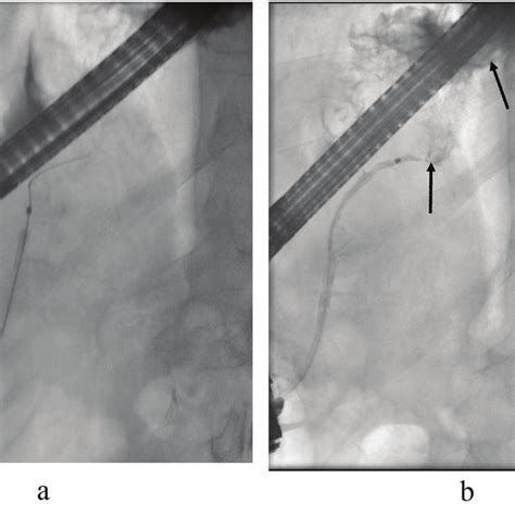 In The First Ercp The Cannula Is In The Pancreatic Duct The Duct Download Scientific Diagram