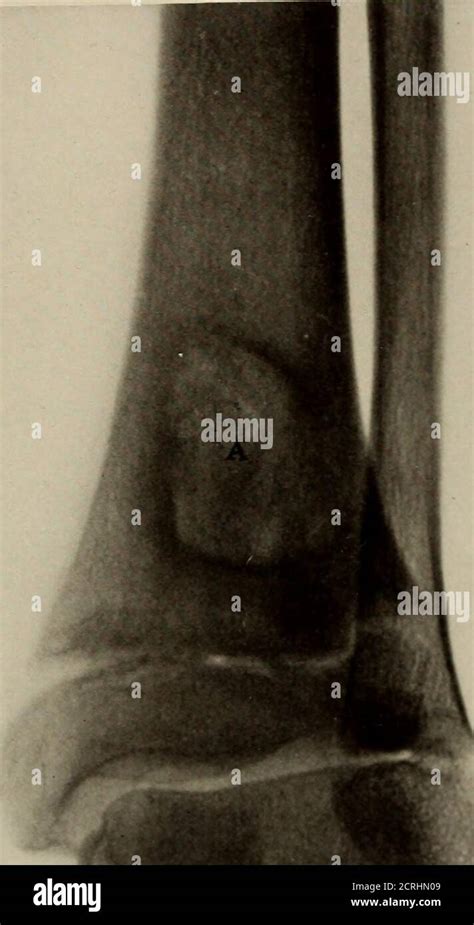 Osteomielitis Tibia Hot Sex Picture